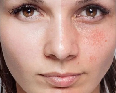 ISO 24558 - Leke Azaltıcı Krem Etkisi Testi